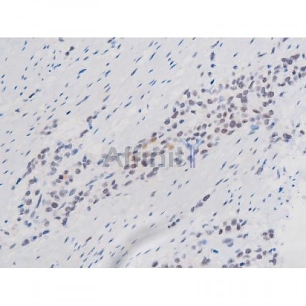 Phospho-STAT1 (Ser727) Antibody - AF3299 at 1/200 staining Human bladder cancer tissue sections by IHC-P.